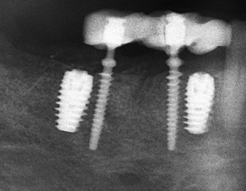 provisorische Implantate